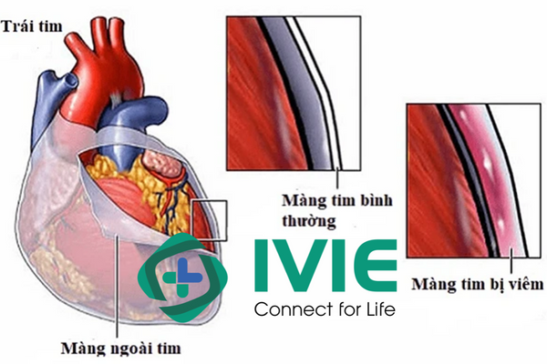Viêm màng ngoài tim co thắt: Nguyên nhân và triệu chứng