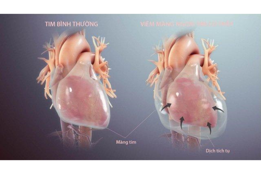 Viêm màng ngoài tim là bệnh lý màng ngoài tim thường gặp nhất trên lâm sàng
