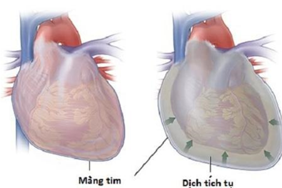 Viêm màng ngoài tim co thắt thường xuất hiện sau các đợt tràn dịch màng ngoài tim