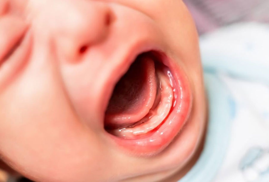 Trẻ sơ sinh 1 tháng tuổi bị nghẹt mũi không được điều trị đúng, tình trạng kéo dài lâu có thể gây viêm mạn tính