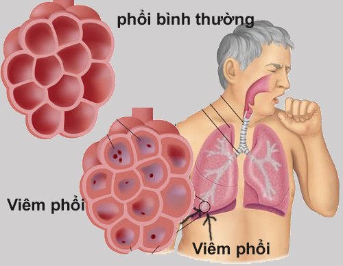 Bệnh viêm phổi