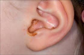 Viêm tai giữa cấp tính được chia làm 3 giai đoạn, mỗi giai đoạn sẽ có những triệu chứng và hướng điều trị khác nhau.