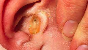Những biến chứng của viêm tai giữa