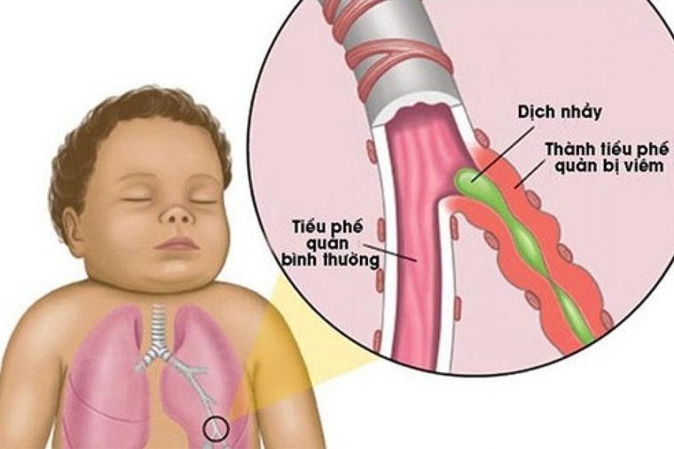 Viêm tiểu phế quản ở trẻ em: Triệu chứng, nguyên nhân, chẩn đoán và cách điều trị