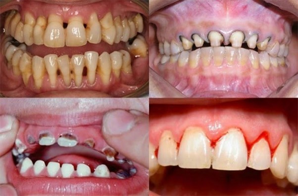 Hình ảnh viêm tủy, lung lay và hư hỏng toàn bộ răng