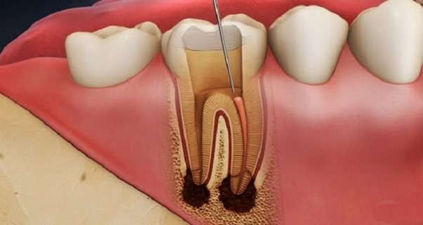Viêm tủy răng có nguy hiểm không? Những lưu ý lấy tủy răng...