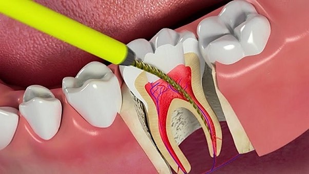 Viêm tủy răng không hồi phục