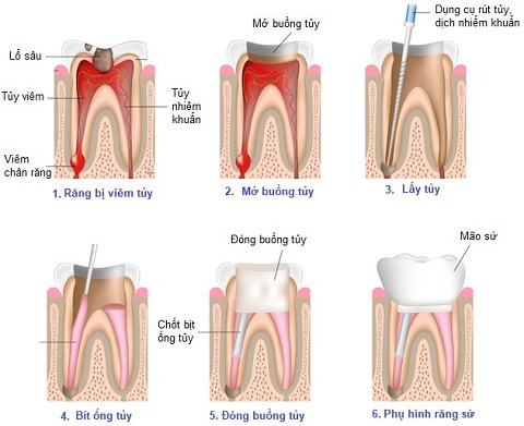 Điều trị tủy lại răng cửa và răng nanh