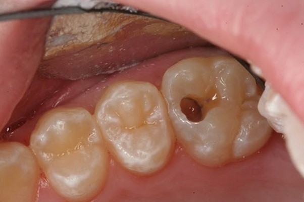 Hình ảnh viêm tủy răng