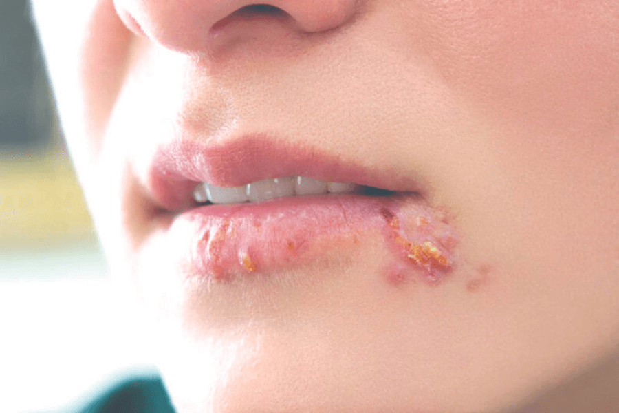 Virus herpes môi.