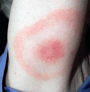 Tổn thương nhiễm Borrlia burgdorferi (Bệnh Lyme)