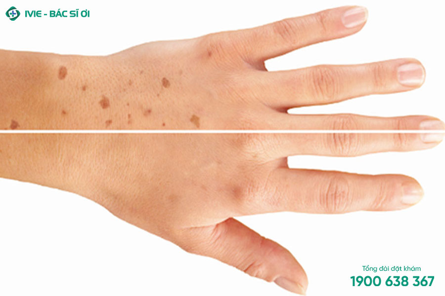Đốm nâu xuất hiện ở bất kỳ vùng da nào trên cơ thể nhuwg tay, chân, mặt