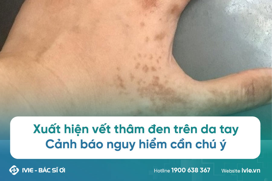 Xuất hiện vết thâm đen trên da tay: Cảnh báo nguy hiểm cần...