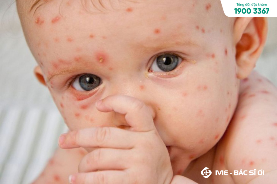 Thủy đậu gây ra các nốt mẩn đỏ trên da của trẻ