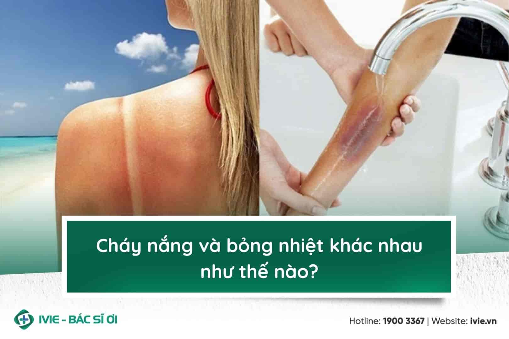 Cháy nắng và bỏng nhiệt khác nhau như thế nào?