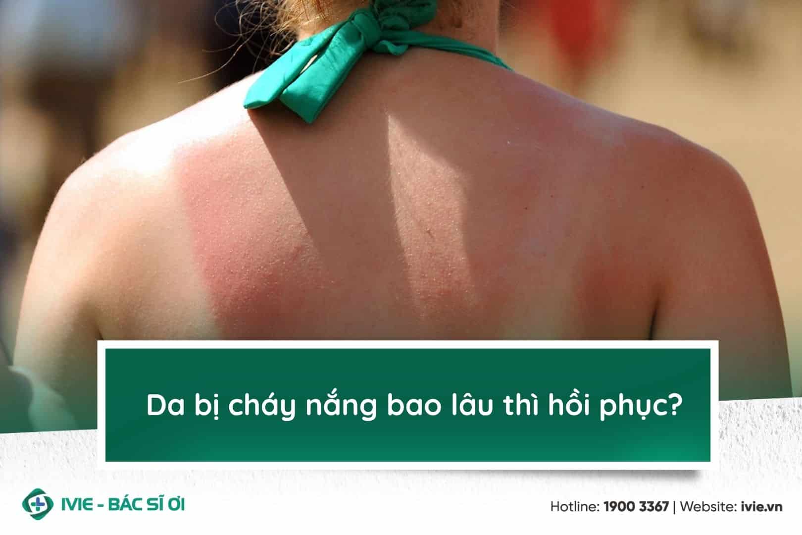 Da bị cháy nắng bao lâu thì hồi phục?