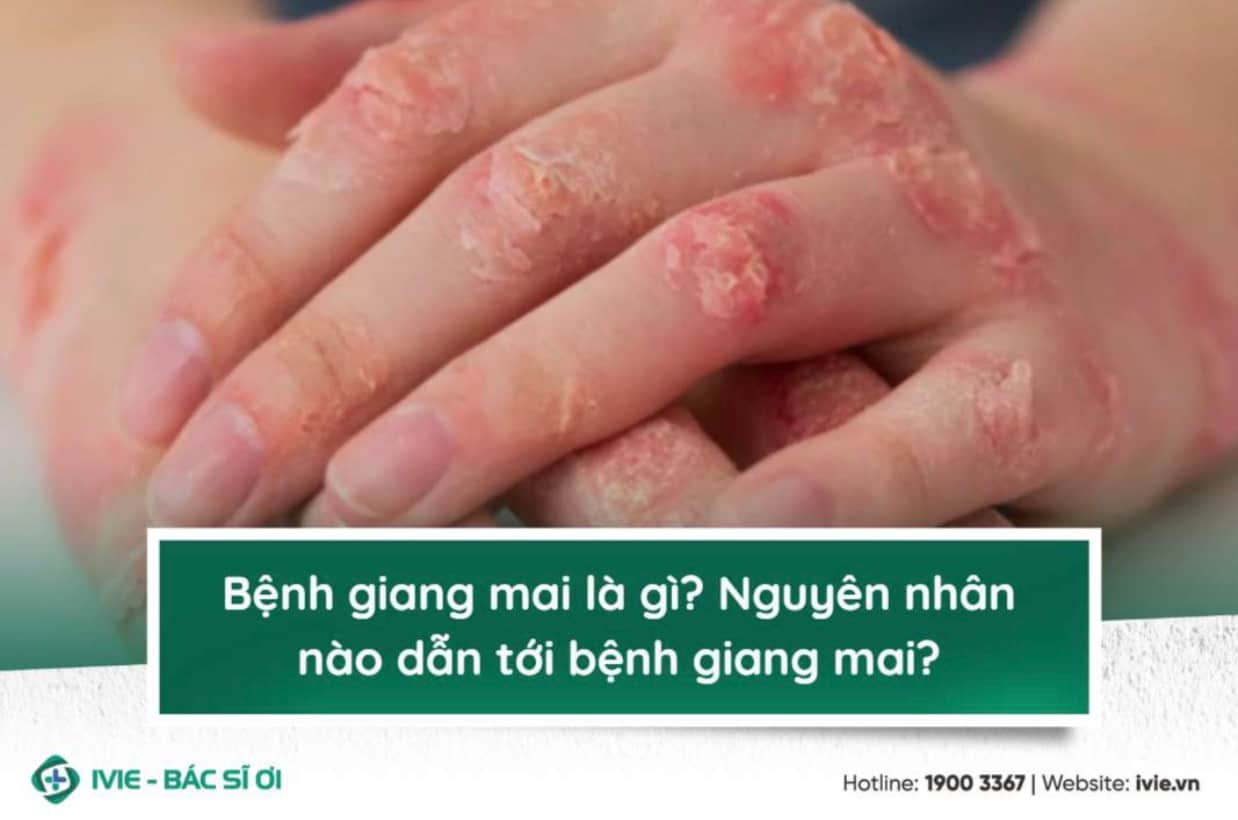 Bệnh giang mai là gì? Nguyên nhân nào dẫn tới bệnh giang...