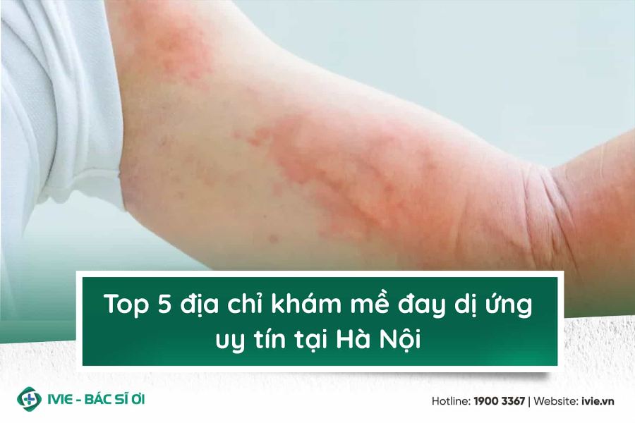 Top 5 địa chỉ khám mề đay dị ứng tại Hà Nội