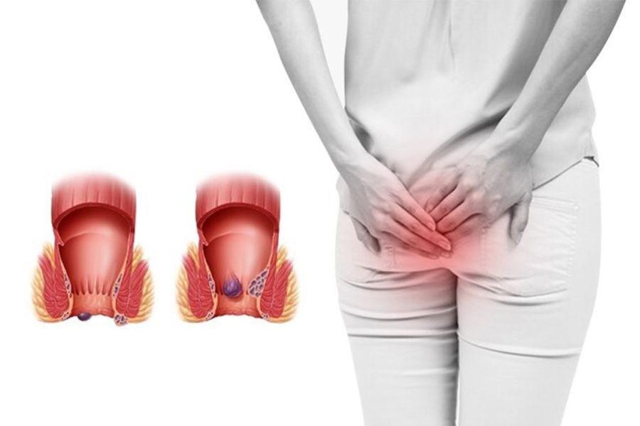Mức hưởng BHYT khi mổ trĩ phụ thuộc vào nhóm đối tượng tham gia và điều kiện khám chữa bệnh