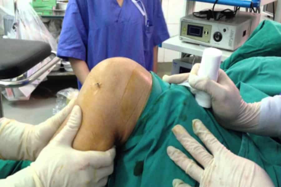 Mức chi trả của bảo hiểm khi phẫu thuật dây chằng chéo trước phụ thuộc lớn vào đối tượng tham gia, mức hưởng, đúng tuyến trái tuyến…