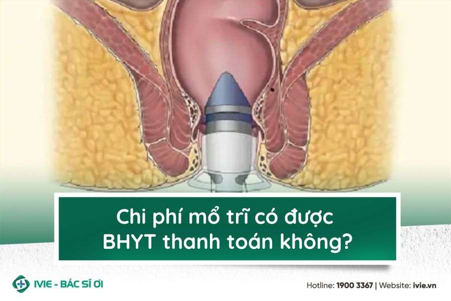 Chi phí mổ trĩ có được BHYT thanh toán không?