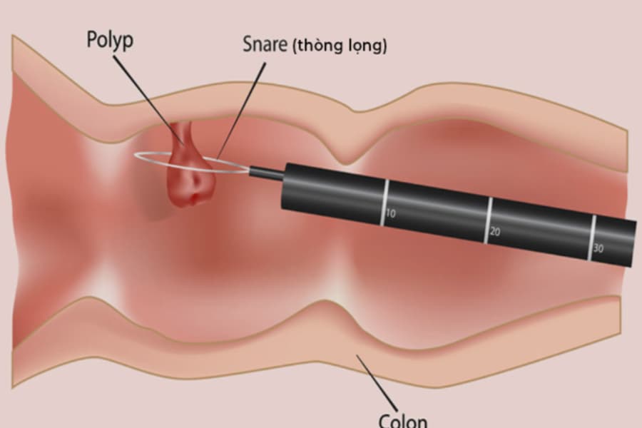 Hình ảnh mô phỏng quy trình nội soi đại tràng để loại bỏ polyp bằng phương pháp thắt và cắt