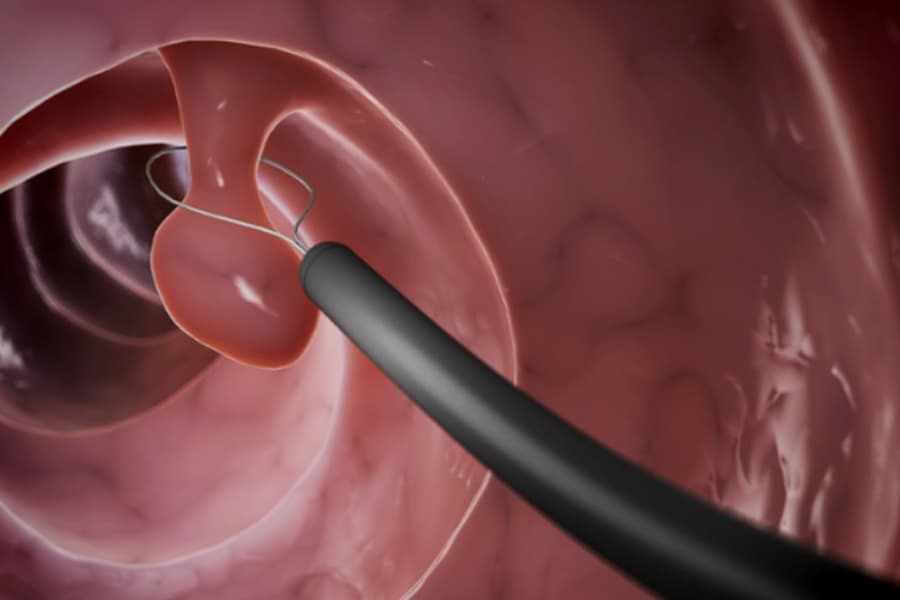 Quy trình được hiển thị là cắt polyp bằng nội soi, trong đó một vòng dây kim loại được sử dụng để thắt và cắt bỏ polyp