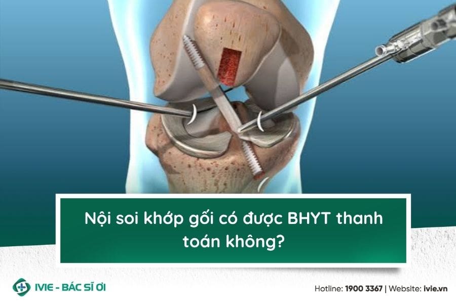 Nội soi khớp gối có được BHYT thanh toán không?