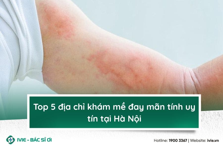Top 5 địa chỉ khám mề đay mãn tính uy tín tại Hà Nội