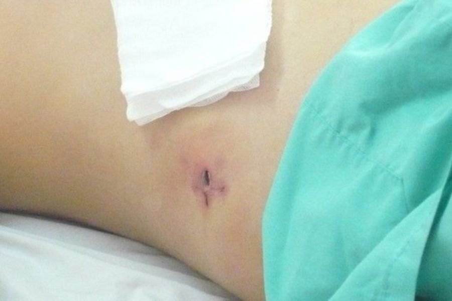 Các dịch vụ theo yêu cầu và phòng điều trị dịch vụ khi phẫu thuật cắt ruột thừa thường không thuộc phạm vi chi trả của BHYT