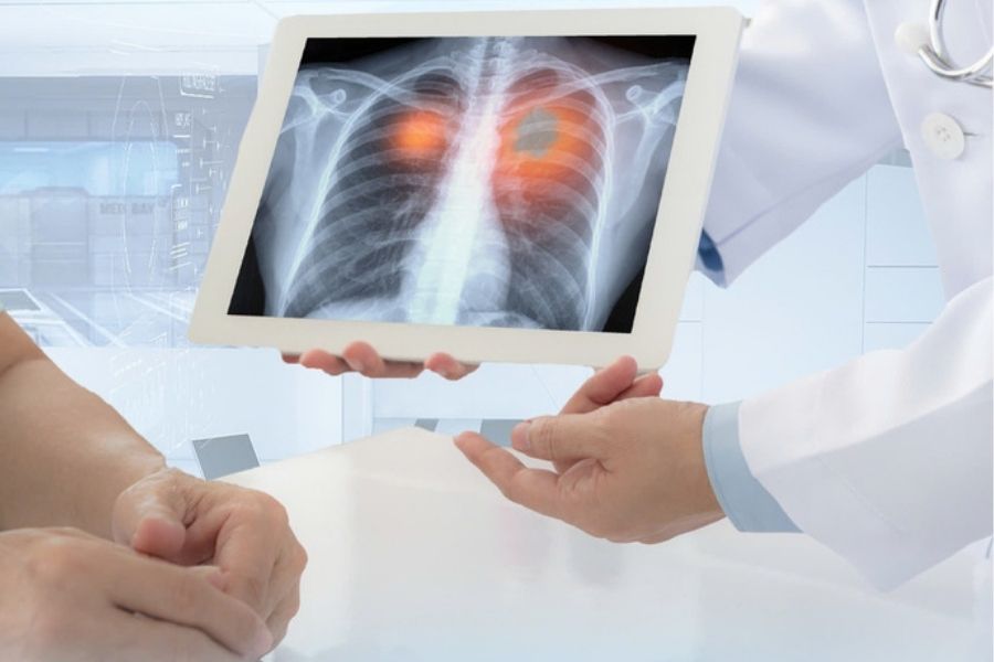 BHYT hỗ trợ nhiều chi phí quan trọng trong điều trị ung thư phổi