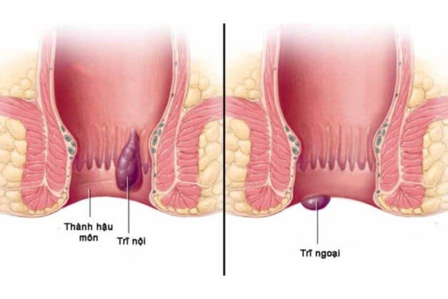 Mổ trĩ thường được chỉ định khi điều trị nội khoa không còn hiệu quả hoặc búi trĩ gây biến chứng ảnh hưởng đến sinh hoạt