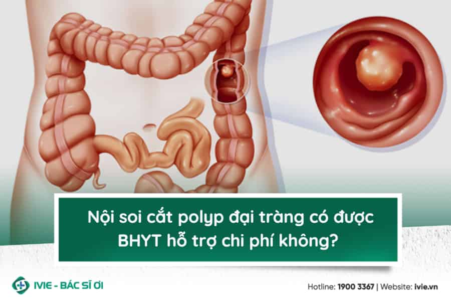 Nội soi cắt polyp đại tràng có được BHYT hỗ trợ chi phí...