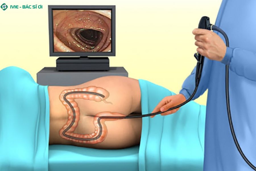 Trường hợp nội soi đại tràng nào cần gây mê 